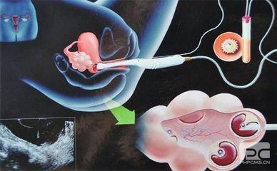 反复流产案例
